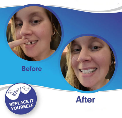 Dental Veneers | Professional Dental Prosthetics with Custom Fit | Restore Your Natural Smile
