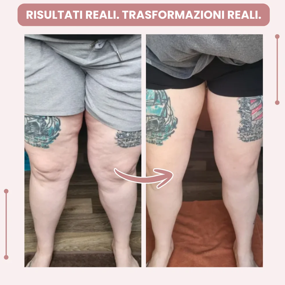 Leggings Donna | Leggings 3D a Vita Alta con Supporto per Lipedema | Comfort e Vestibilità Ottimale per Uso Quotidiano 3