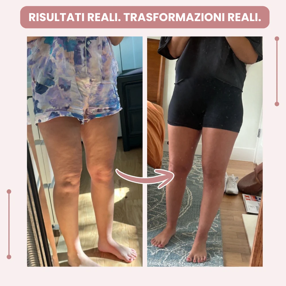 Leggings Donna | Leggings 3D a Vita Alta con Supporto per Lipedema | Comfort e Vestibilità Ottimale per Uso Quotidiano 6