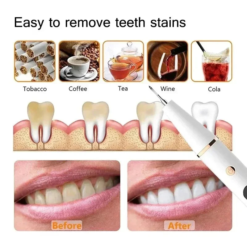 Pulitore Elettrico per Denti | Scaler Sonico Portatile con Luce LED per Rimozione Efficace di Placca e Tartaro 2